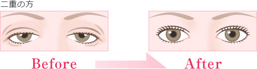 腱膜性眼瞼下垂 二重の方
